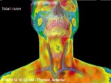 infrarood-medische-thermografie-thyroid